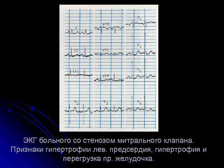 ЭКГ больного со стенозом митрального клапана. Признаки гипертрофии лев. предсердия, гипертрофия и перегрузка пр.