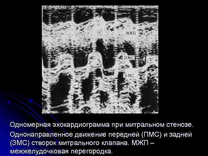  Одномерная эхокардиограмма при митральном стенозе. Однонаправленное движение передней (ПМС) и задней (ЗМС) створок