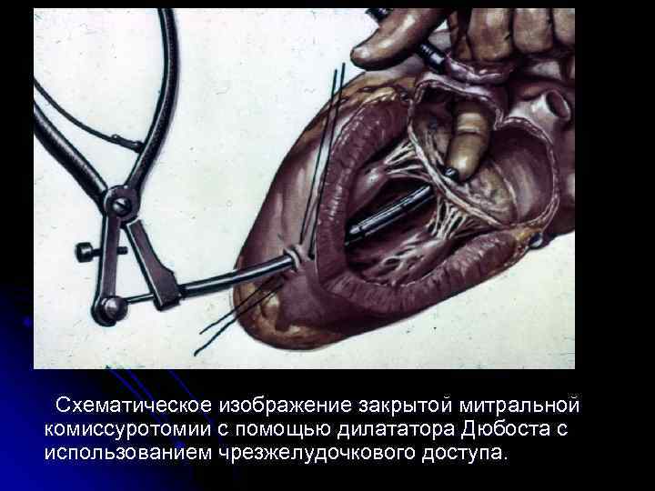 Схематическое изображение закрытой митральной комиссуротомии с помощью дилататора Дюбоста с использованием чрезжелудочкового доступа.