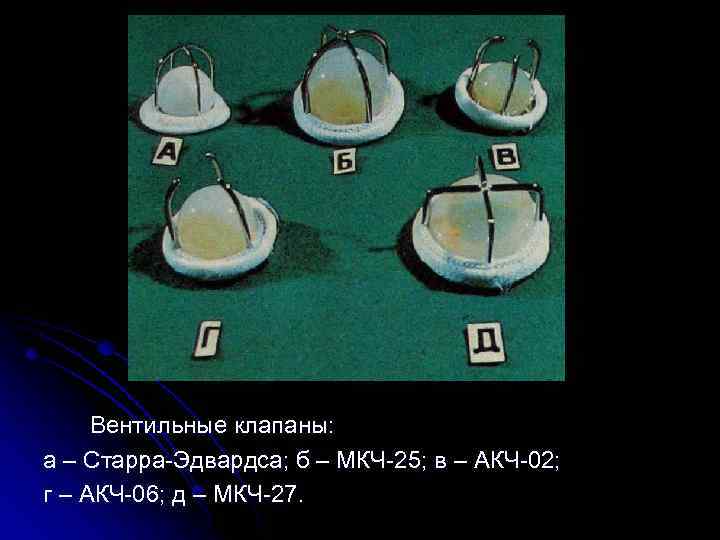  Вентильные клапаны: а – Старра-Эдвардса; б – МКЧ-25; в – АКЧ-02; г –