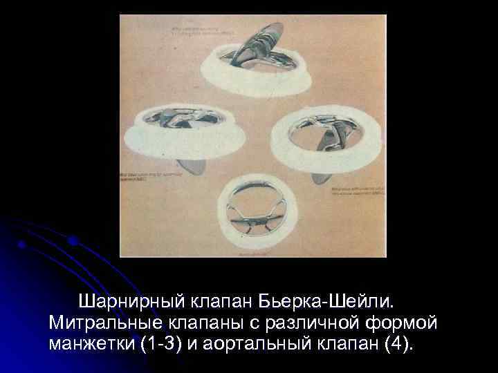  Шарнирный клапан Бьерка-Шейли. Митральные клапаны с различной формой манжетки (1 -3) и аортальный