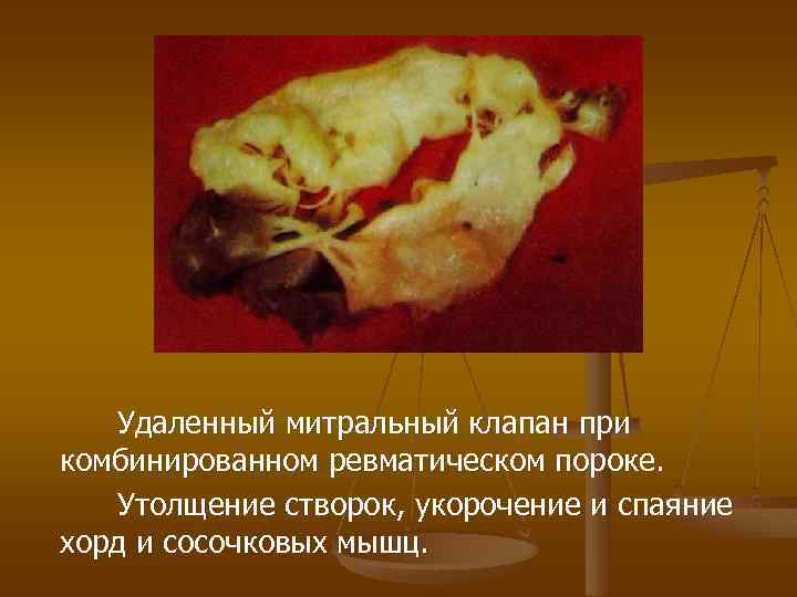 Удаленный митральный клапан при комбинированном ревматическом пороке. Утолщение створок, укорочение и спаяние хорд и
