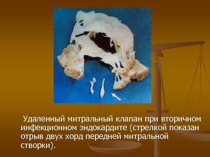 Удаленный митральный клапан при вторичном инфекционном эндокардите (стрелкой показан отрыв двух хорд передней митральной
