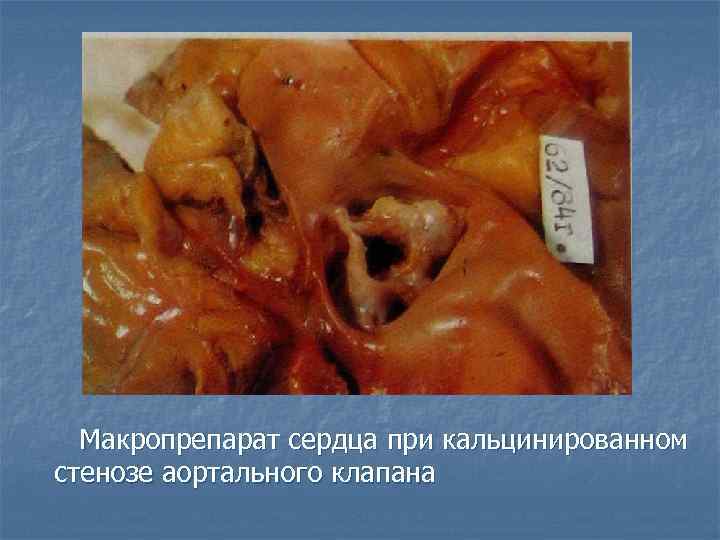Макропрепарат сердца при кальцинированном стенозе аортального клапана 