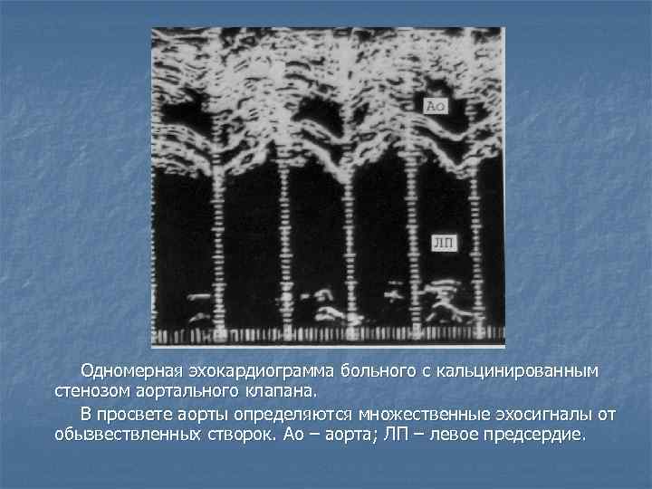 Одномерная эхокардиограмма больного с кальцинированным стенозом аортального клапана. В просвете аорты определяются множественные эхосигналы
