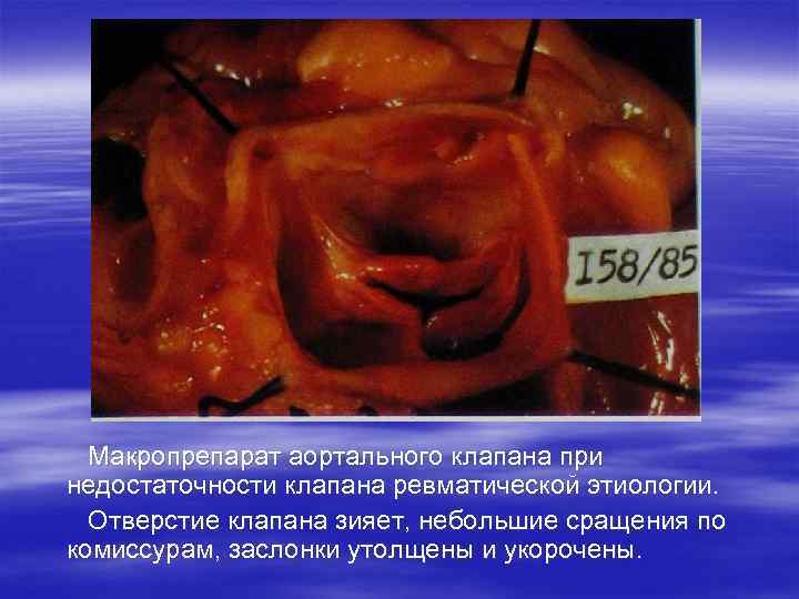  Макропрепарат аортального клапана при недостаточности клапана ревматической этиологии. Отверстие клапана зияет, небольшие сращения