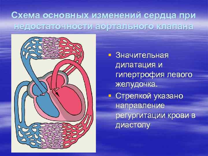 Схема основных изменений сердца при недостаточности аортального клапана § Значительная дилатация и гипертрофия левого