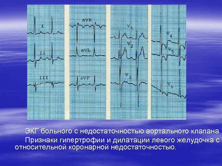  ЭКГ больного с недостаточностью аортального клапана. Признаки гипертрофии и дилатации левого желудочка с