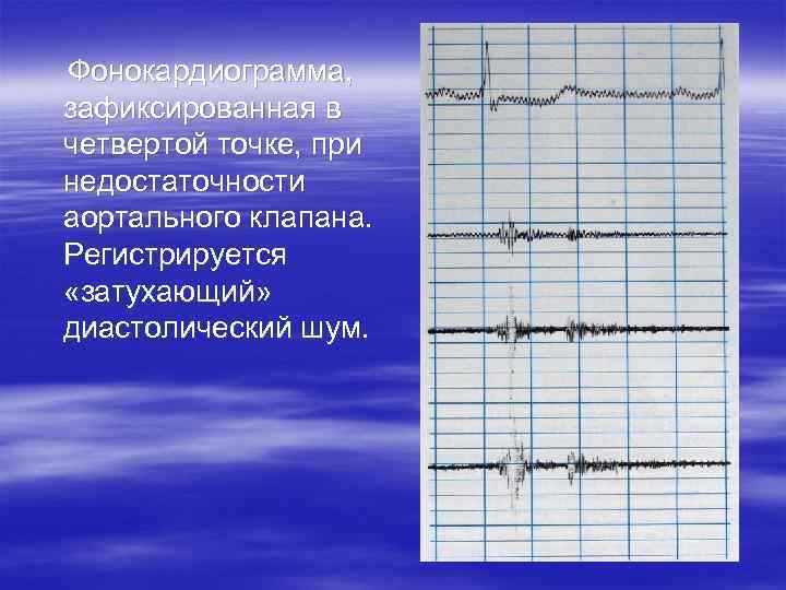  Фонокардиограмма, зафиксированная в четвертой точке, при недостаточности аортального клапана. Регистрируется «затухающий» диастолический шум.