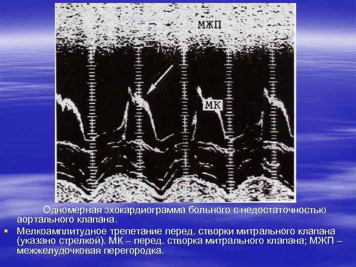  Одномерная эхокардиограмма больного с недостаточностью аортального клапана. § Мелкоамплитудное трепетание перед. створки митрального