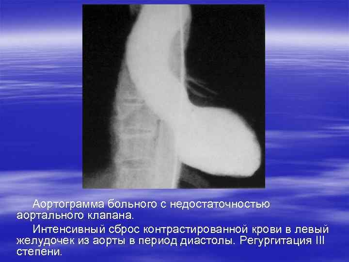  Аортограмма больного с недостаточностью аортального клапана. Интенсивный сброс контрастированной крови в левый желудочек