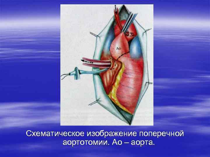Схематическое изображение поперечной аортотомии. Ао – аорта. 