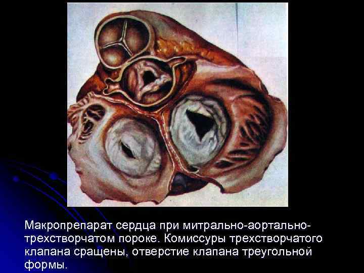  Макропрепарат сердца при митрально-аортальнотрехстворчатом пороке. Комиссуры трехстворчатого клапана сращены, отверстие клапана треугольной формы.
