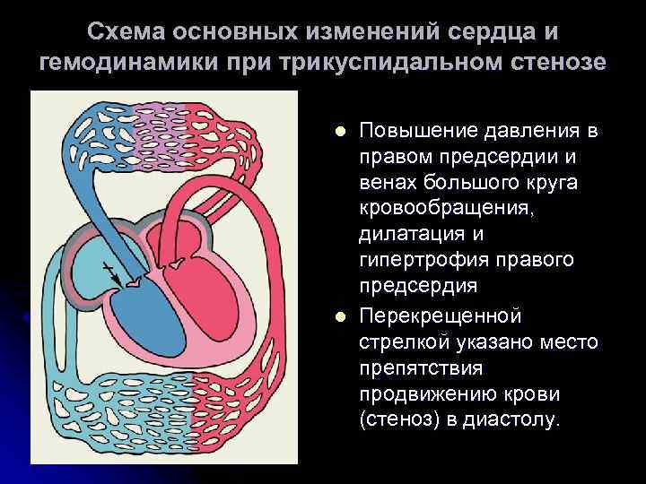 Дилатация камер сердца