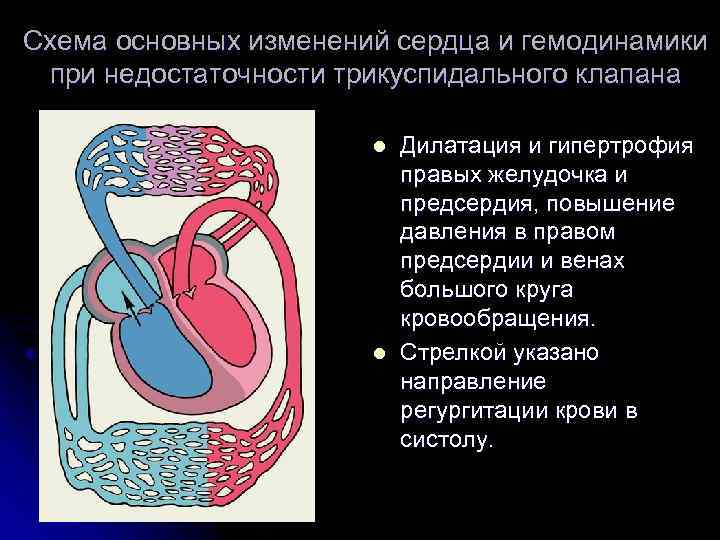 Отрыв хорды трикуспидального клапана