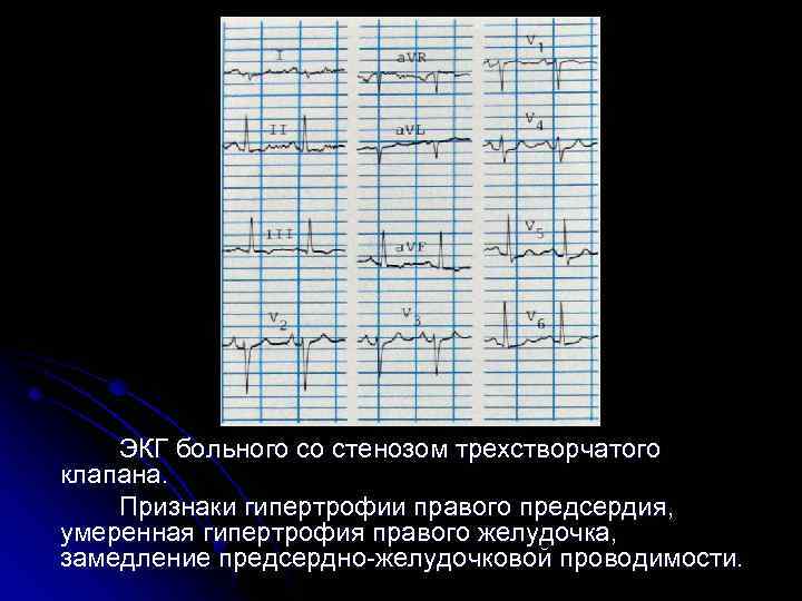  ЭКГ больного со стенозом трехстворчатого клапана. Признаки гипертрофии правого предсердия, умеренная гипертрофия правого