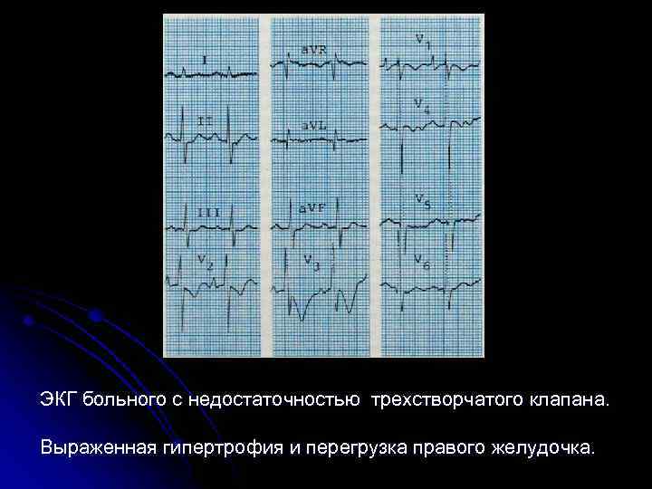 Перегрузка правого желудочка