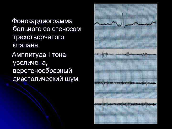  Фонокардиограмма больного со стенозом трехстворчатого клапана. Амплитуда I тона увеличена, веретенообразный диастолический шум.