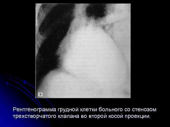  Рентгенограмма грудной клетки больного со стенозом трехстворчатого клапана во второй косой проекции. 