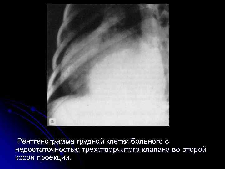  Рентгенограмма грудной клетки больного с недостаточностью трехстворчатого клапана во второй косой проекции. 