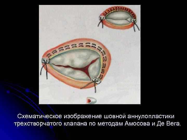  Схематическое изображение шовной аннулопластики трехстворчатого клапана по методам Амосова и Де Вега. 