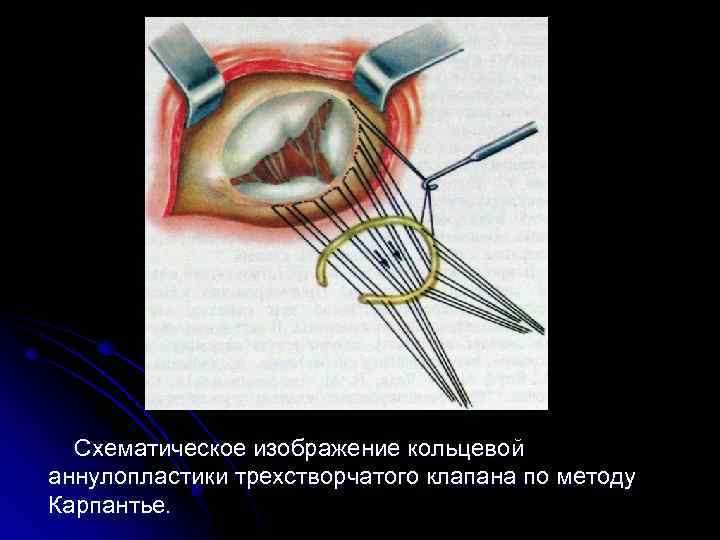  Схематическое изображение кольцевой аннулопластики трехстворчатого клапана по методу Карпантье. 