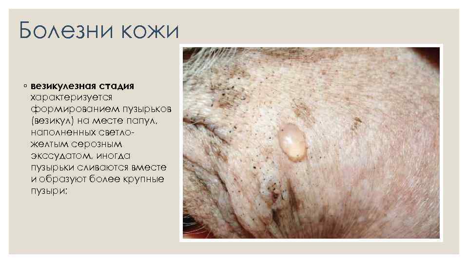 Болезни кожи ◦ везикулезная стадия характеризуется формированием пузырьков (везикул) на месте папул, наполненных светло