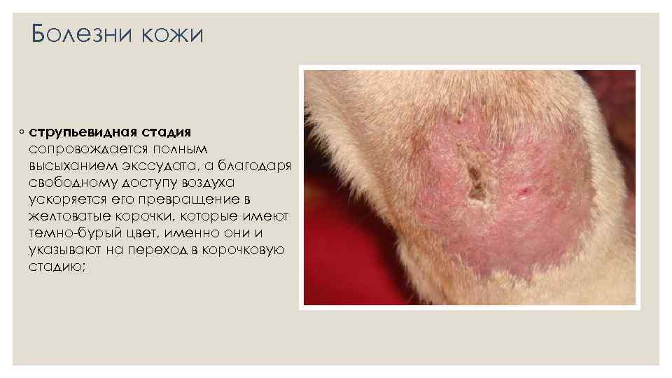 Болезни кожи ◦ струпьевидная стадия сопровождается полным высыханием экссудата, а благодаря свободному доступу воздуха