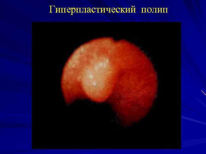 Гиперпластический полип 
