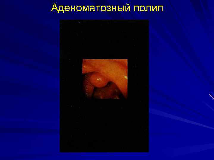 Аденоматозный полип 