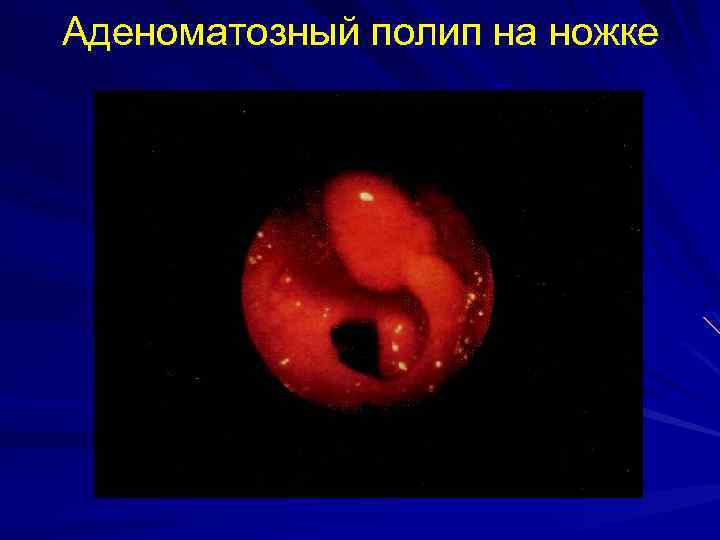 Аденоматозный полип на ножке 