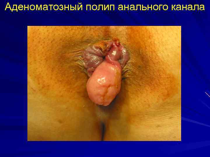 Аденоматозный полип анального канала 