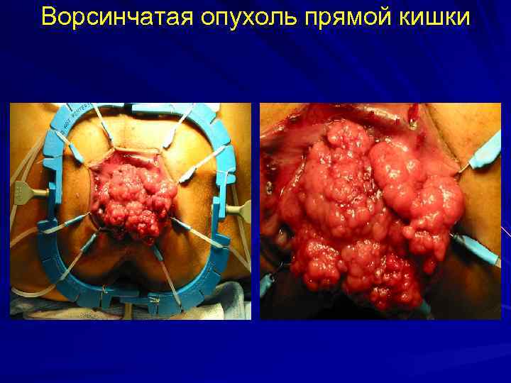 Ворсинчатая опухоль прямой кишки 