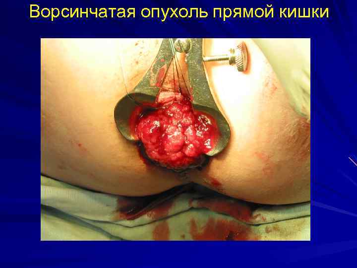 Ворсинчатая опухоль прямой кишки 