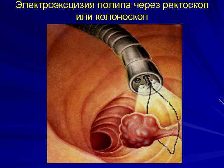 Электроэксцизия полипа через ректоскоп или колоноскоп 