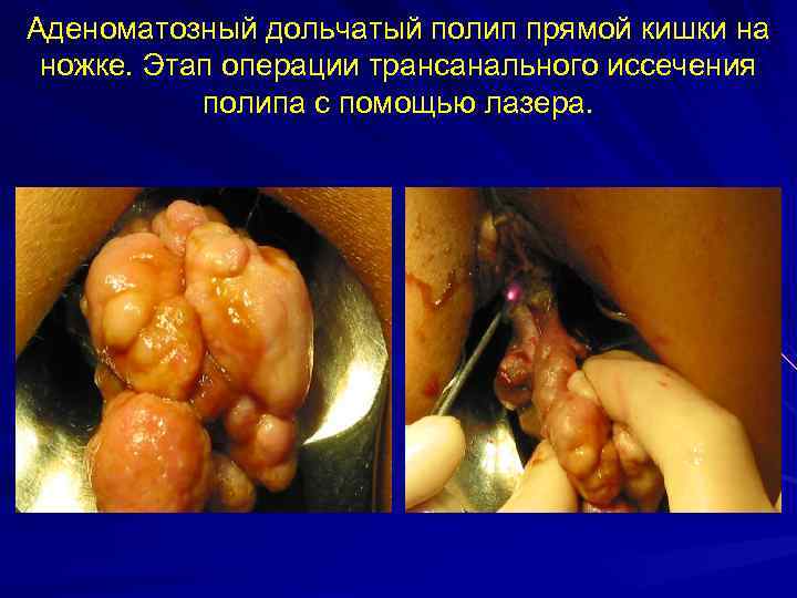 Аденоматозный дольчатый полип прямой кишки на ножке. Этап операции трансанального иссечения полипа с помощью