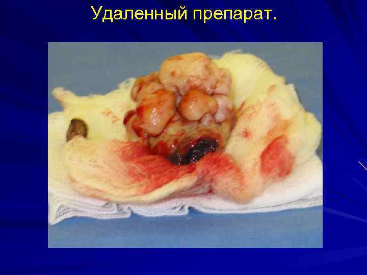 Удаленный препарат. 