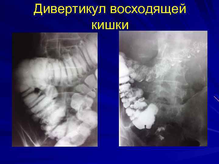 Дивертикул восходящей кишки 