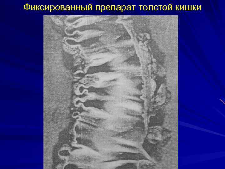 Фиксированный препарат толстой кишки 