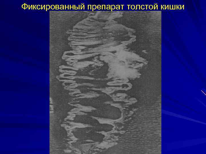 Фиксированный препарат толстой кишки 