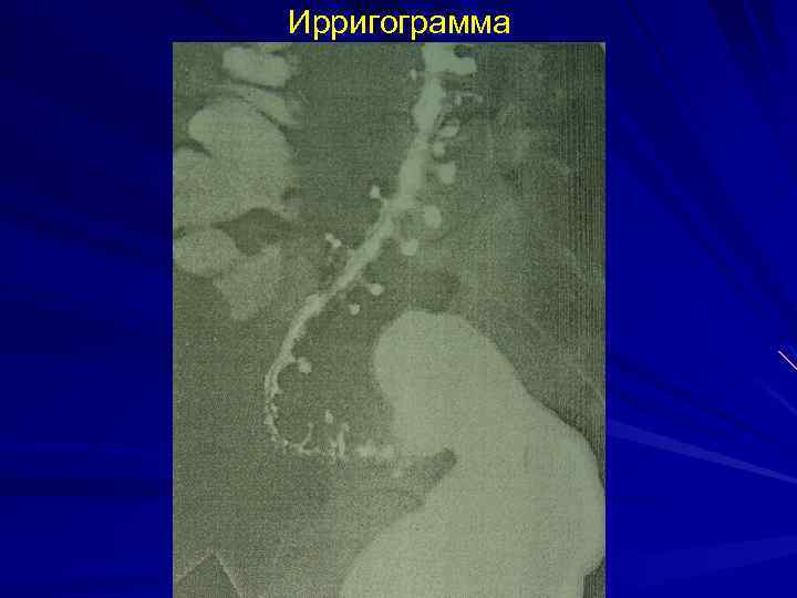 Ирригограмма 