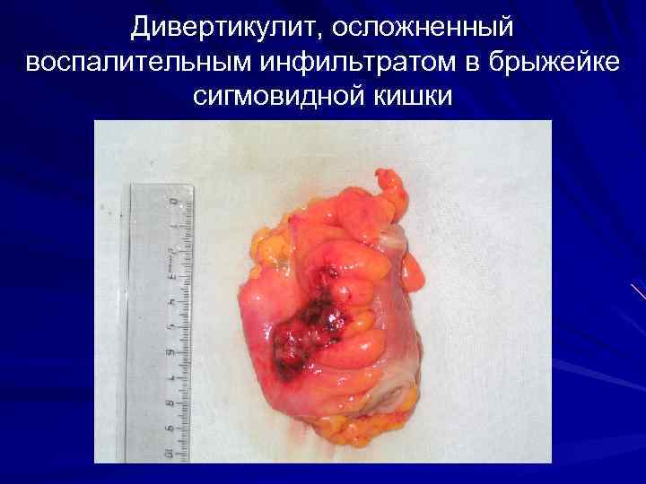 Дивертикулит, осложненный воспалительным инфильтратом в брыжейке сигмовидной кишки 