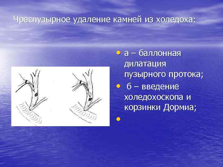 Чреспузырное удаление камней из холедоха: • а – баллонная • • дилатация пузырного протока;