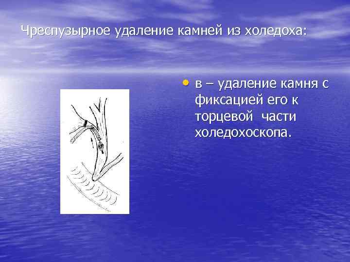 Чреспузырное удаление камней из холедоха: • в – удаление камня с фиксацией его к