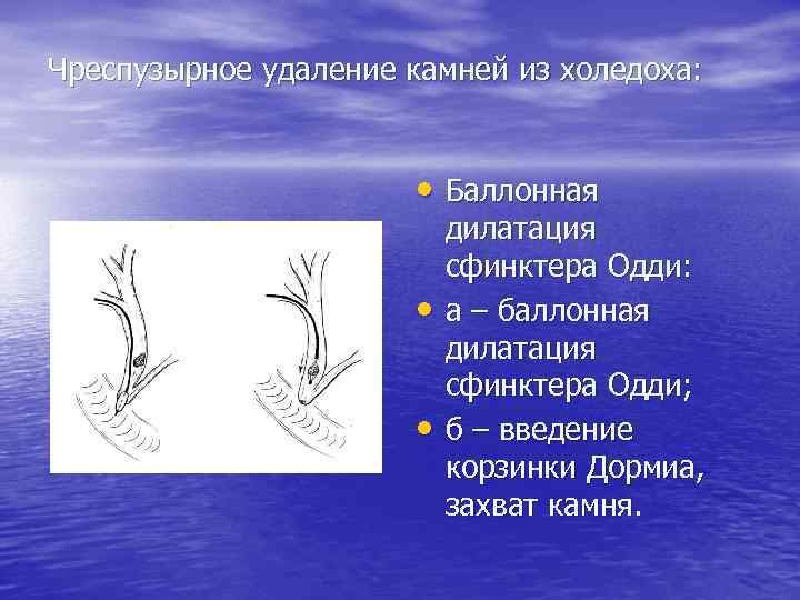 Чреспузырное удаление камней из холедоха: • Баллонная • • дилатация сфинктера Одди: а –