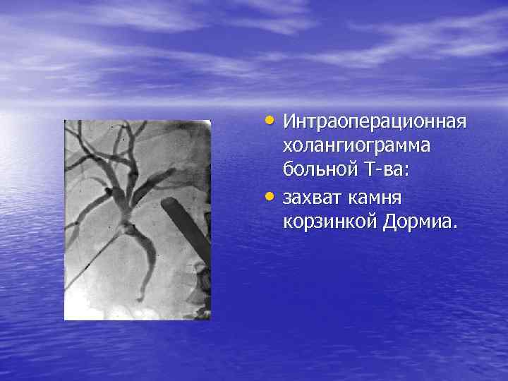  • Интраоперационная • холангиограмма больной Т ва: захват камня корзинкой Дормиа. 