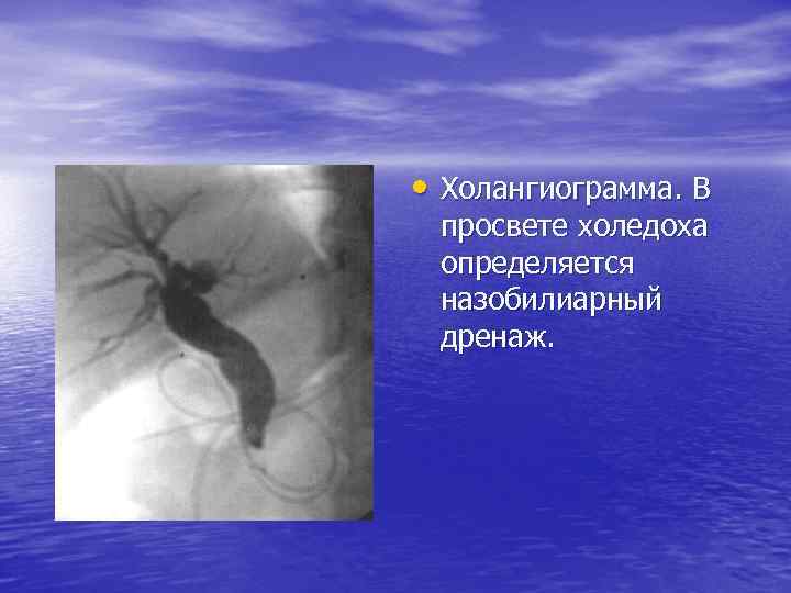  • Холангиограмма. В просвете холедоха определяется назобилиарный дренаж. 