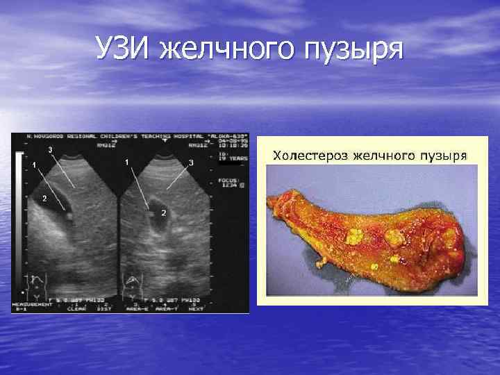 Холестероз желчного пузыря на узи фото