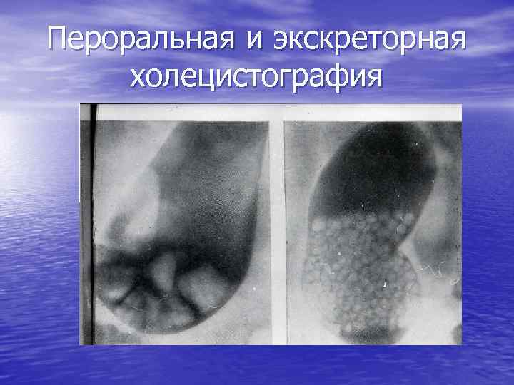 Пероральная и экскреторная холецистография 