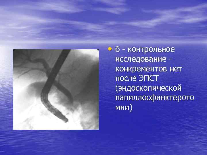  • б контрольное исследование конкрементов нет после ЭПСТ (эндоскопической папиллосфинктерото мии) 